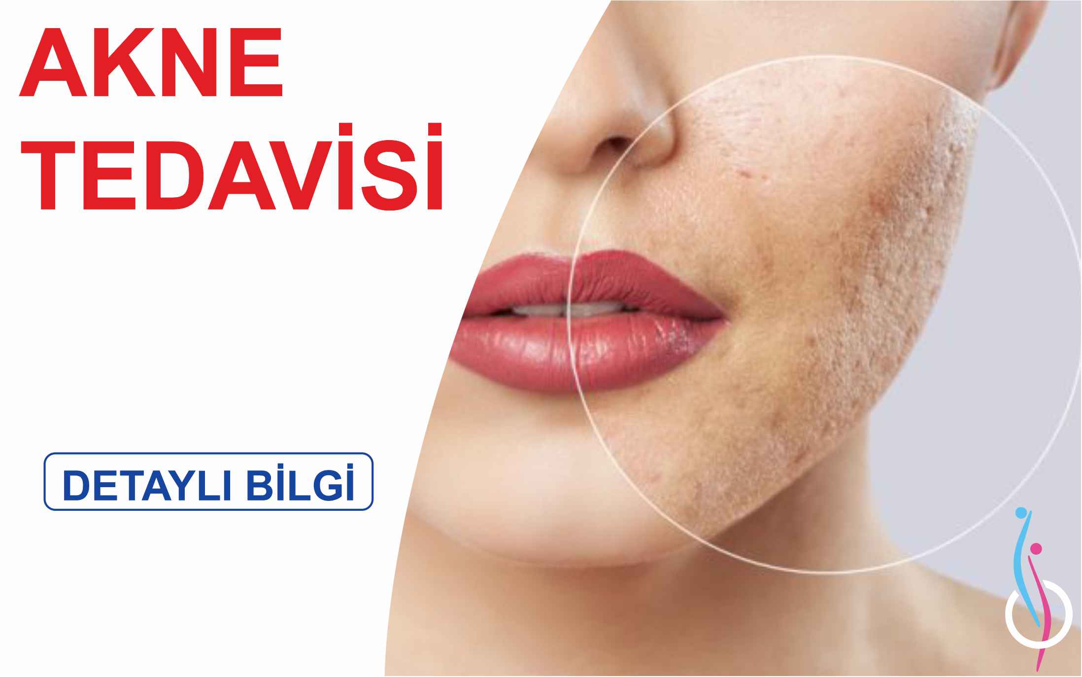 AKNE TEDAVİSİ-min (1)